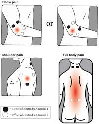 43 Disclosed Tens Electrode Placement Chart Pdf