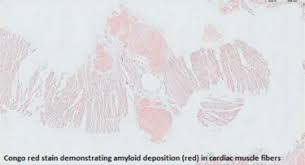 Terms such as primary amyloidosis, secondary the vast majority of cardiac amyloidosis is caused by one of two proteins: Rapidly Progressive Heart Failure From Light Chain Cardiac Amyloidosis Journal Of Cardiac Failure