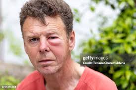 403 Bee Sting Stock Photos, High-Res Pictures, and Images