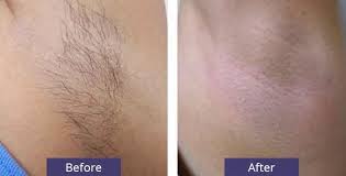 We're dedicated to offer the best skincare treatments with 100% patient satisfaction every time. Laser Hair Removal Seattle Hair Removal Cost Seattle Plastic Surgery