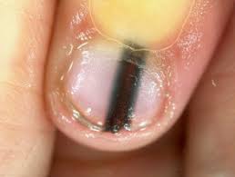 If you have ever had white lines or dots on your nails, you may already know that it is either because of mineral deficiency (like calcium and zinc) or due to an injury at the base of according to the american academy of dermatology (aad), a black line on nails or toes might be a symptom of skin cancer. Black Longitudinal Toenail Line Should I Worry Compleet Feet