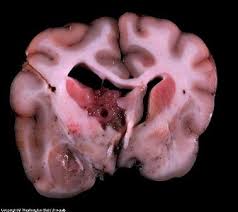 Dogs may be unable to find their way home, may not the symptoms a dog with a brain tumour exhibits vary based upon where in the brain the tumour is growing. Dog Brain Tumor Symptoms