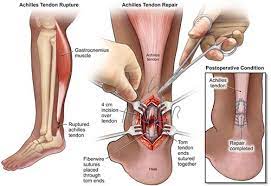 Check spelling or type a new query. Achilles Tendon Surgery Nyc Achilles Tendon Tear Repair
