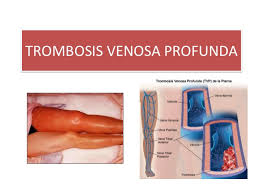 La trombosis venosa superficial es más fácil de detectar. Trombosis Venosa Profunda