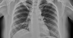 An atheromatous aorta is one that has plaque formation lining the wall of the aorta which is the major blood vessel that leaves the heart. Lordotic Cxr Sumer S Radiology Blog
