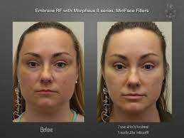 Embracerf is actually a combination of 2 procedures, facetite and morpheus8, performed one after the other as follows (see animation): Embracerf Case 4828 New Orleans Premier Center For Aesthetics And Plastic Surgery