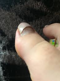 Image result for Akutní zánět nehtového lůžka