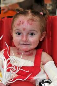 Kulit menggelupas seperti serangga