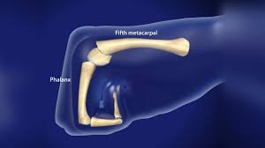 Image result for Fracture