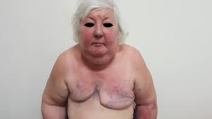 It can be difficult to treat and may require a purpose: Pseudoangioedema Intechopen