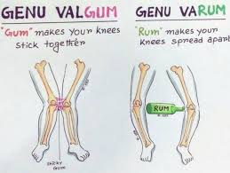 Image result for Genu Varum
