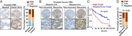 Stage iv prostate cancer prognosis. Trop2 Is A Driver Of Metastatic Prostate Cancer With Neuroendocrine Phenotype Via Parp1 Pnas