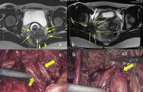 A pilot systematic review of the effects of aromatase inhibitors on pain associated with endometriosis. Postoperative Outcomes After Surgery For Deep Endometriosis Of The Sacral Plexus And Sciatic Nerve A 52 Patient Consecutive Series Journal Of Minimally Invasive Gynecology