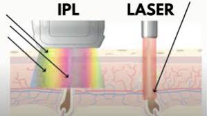 How does ipl hair removal work? The Difference Between Ipl And Laser Hair Removal How To Choose