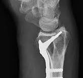 Distal Radius Fracture: Diagnosis, Treatment, Recovery