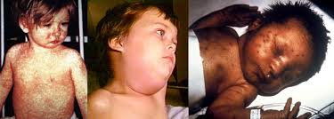 How Do You Change An Anti-Vaccine Parent's Mind? Scare The Crap Out Of Them