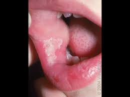 Image result for Canker sores symptoms roof of the mouth