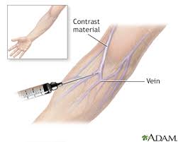 Image result for Intravenous Pyelogram