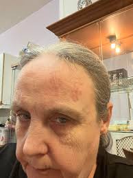 Firework accident at Evergreen Park