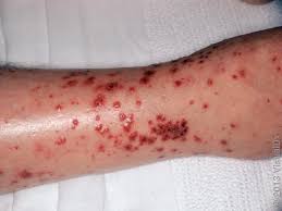 Image result for allergy rash on the legs