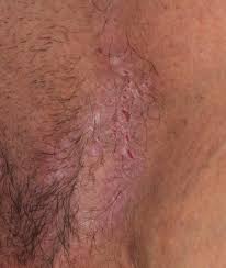 Image result for sore skin in the groin area