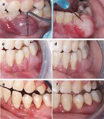 Image result for granuloma gum disease