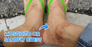 Bug Bites That Look Like Mosquito Bites But Hurt 7 Insect Bites Singaporeans Have Gotten At Some Point How To Identify Them