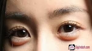 Warna di kulit bawah mata yang gelap juga boleh berlaku akibat pembengkakan. Cara Mudah Untuk Hilangkan Eyebag Dan Ketahui Punca Eyebag Berlaku