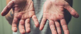 Hand Fuss Mund Krankheit Symptome Behandlung