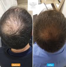 Progress is slow, but the quality of my hair has significantly improved. Male Hair Loss What You Need To Know Hair Transplant Clinic London