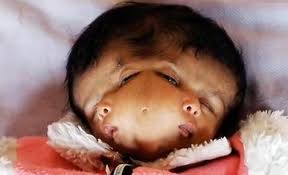 Image result for deformed babies in Iraq caused by depleted uranium