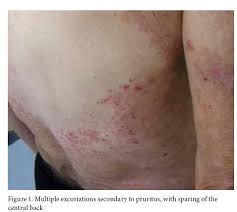 In most cases, itchy skin rash appears to be mild initially. Rashes In The Elderly Identification And Treatment