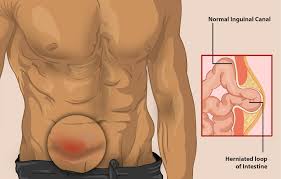Image result for Inguinal hernia man