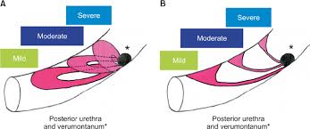 Aggressive Diagnosis And Treatment For Posterior Urethral Valve As An Etiology For Vesicoureteral Reflux Or Urge Incontinence In Children