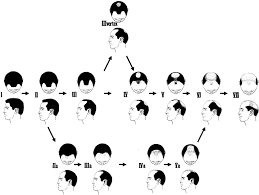 How To Use Genetics To Figure Out If Youll Go Bald Vox