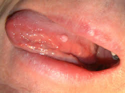 In most patients, there may be a few to no symptoms in the early stages of tongue cancer. New Park Dental Devizes Popular Dental Practice Based In Devizes Wiltshire