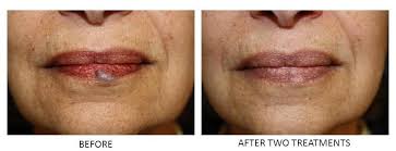 A dermatologist explains why people get lip pimples, how to treat it, and how to prevent it. Non Surgical Laser Treatment For Blue Bumps On Lips Skincare Physicians