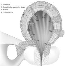 Image result for Bladder Cancer Staging