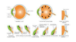 Learn if you may be at risk for it, what to look for, and how to get treated. Glaucoma Treatment Iristech