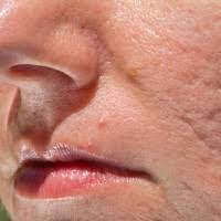 They're not medically necessary and are not covered by insurance, so it would be very. What Is The Cost Involved In The Treatment Of Acne Scars