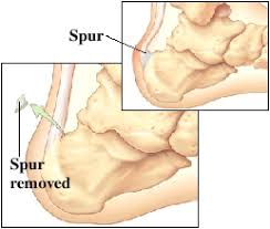 Learn what causes these bony growths, and how to treat them. Foot Surgery Bone Spurs Saint Luke S Health System