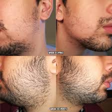 How do i grow a beard faster? Derma Roller Beard Minoxidil