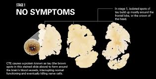 The latest news and opinion concerning chronic traumatic encephalopathy (cte). How Cte Affects The Brain League Of Denial The Nfl S Concussion Crisis Frontline Pbs Official Site