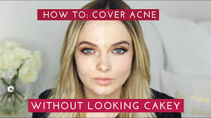 how to cover acne s without
