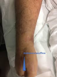 Dorsal Radial Artery Catheterization For Invasive Blood Pressure Monitoring Treatment, as with all fractures, includes. dorsal radial artery catheterization