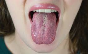 Image result for black tongue symptoms