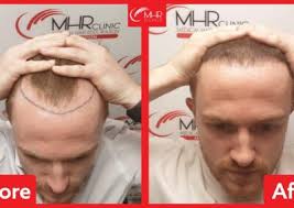 MHR Hair Restoration Results