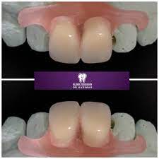 We did not find results for: Gigi Palsu Depan Valplast Klinik Pergigian Dr Karimah Facebook