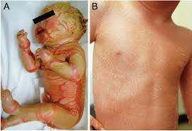Image result for Ichthyosis
