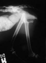 Image result for Megacolon